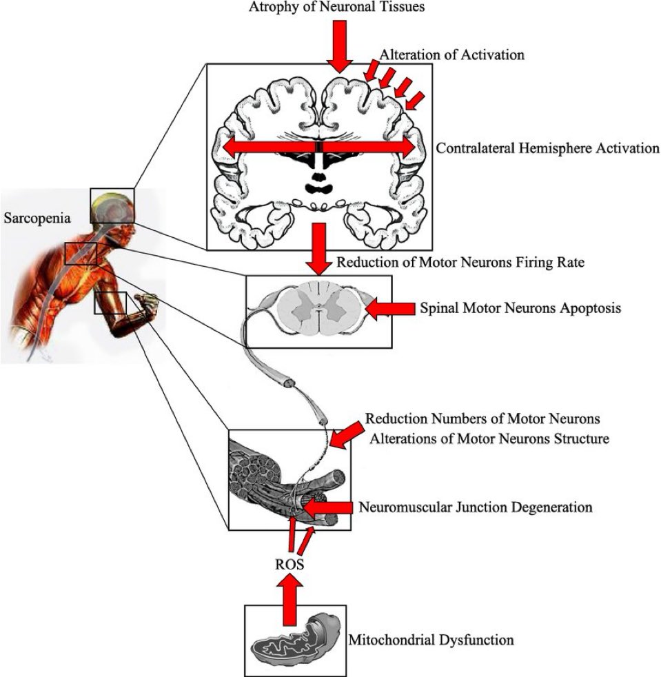 Neuromuscular factors responsible for age-related sarcopenia👇🏼

✅reduced cortical inputs
✅increased cerebral cortex atrophy
✅increased motor-neurons apoptosis
✅NMJ impairment 
✅increased reactive oxygen species (mitochondrial dysfunction)

#muscle 

link.springer.com/article/10.100…