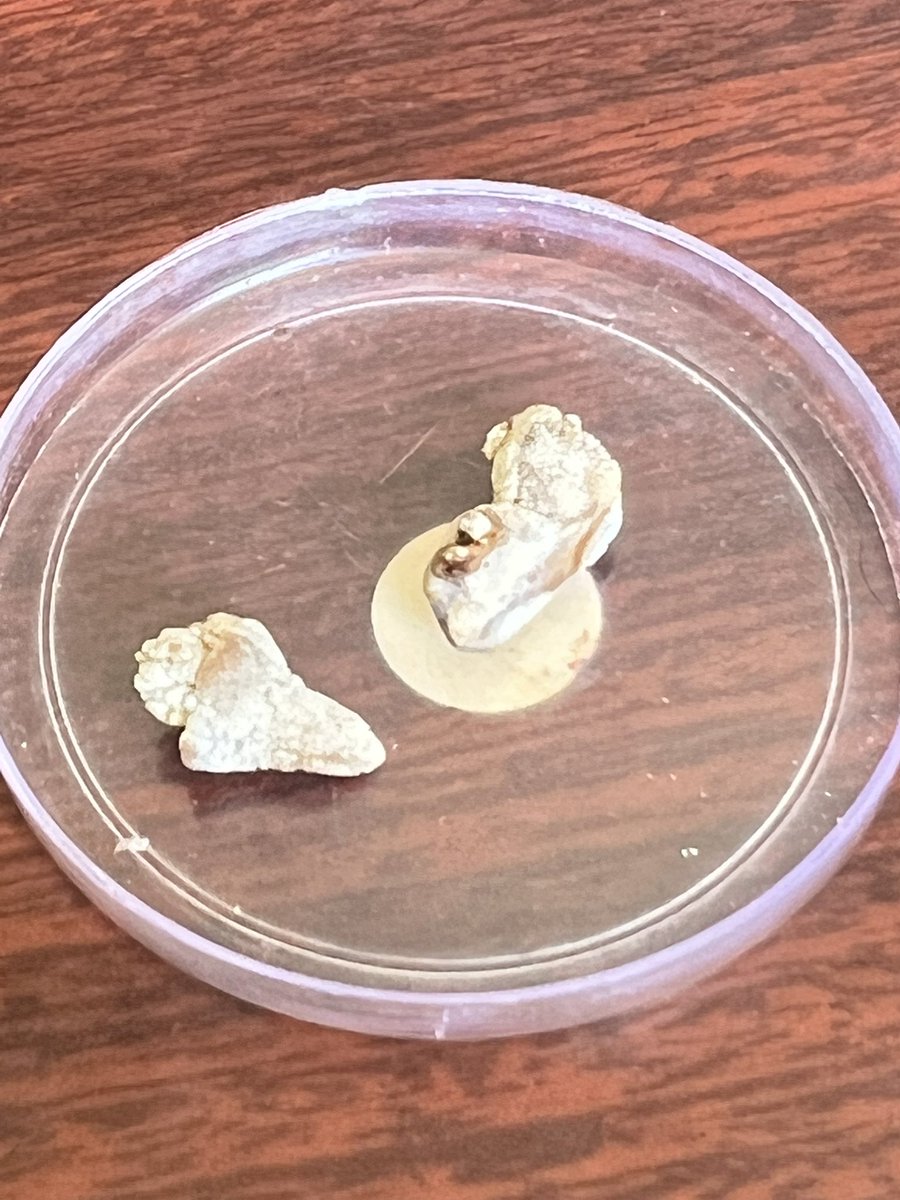 “ I told you I will not need surgery ” . 😲🤔😱<a href="/TFL_URO_APIS/">APIS KidneyStone Institute, TFL EndoUrology Center</a> <a href="/endouroacademy/">Endourology Academy</a> <a href="/mohamed92902484/">mohamed elshazly</a> <a href="/Endo_Society/">Endourological Society</a> <a href="/sbinhamrii/">Saeed Bin Hamri</a> <a href="/drkemalsarica/">Kemal Sarıca</a> <a href="/GRUrology/">Grand Rounds Urology</a> 
#17 mm /15 mm !