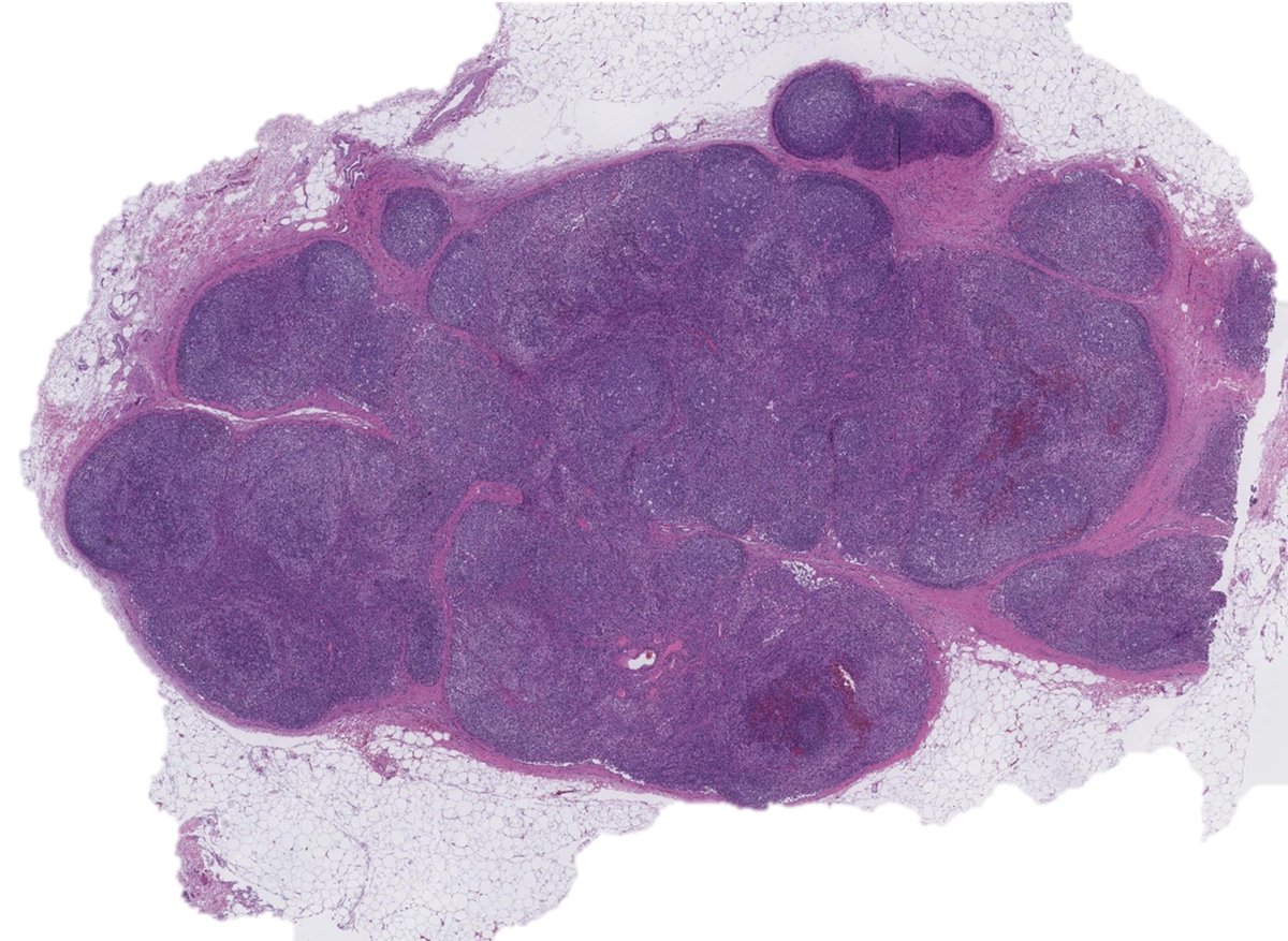 Illustration of the danger of inadvertently sampling germinal centers in limited core-needle biopsies, particularly in the setting of lymphadenopathy with follicular hyperplasia➡️area circled in red with large centroblasts, is an enlarged germinal center (with dark and light