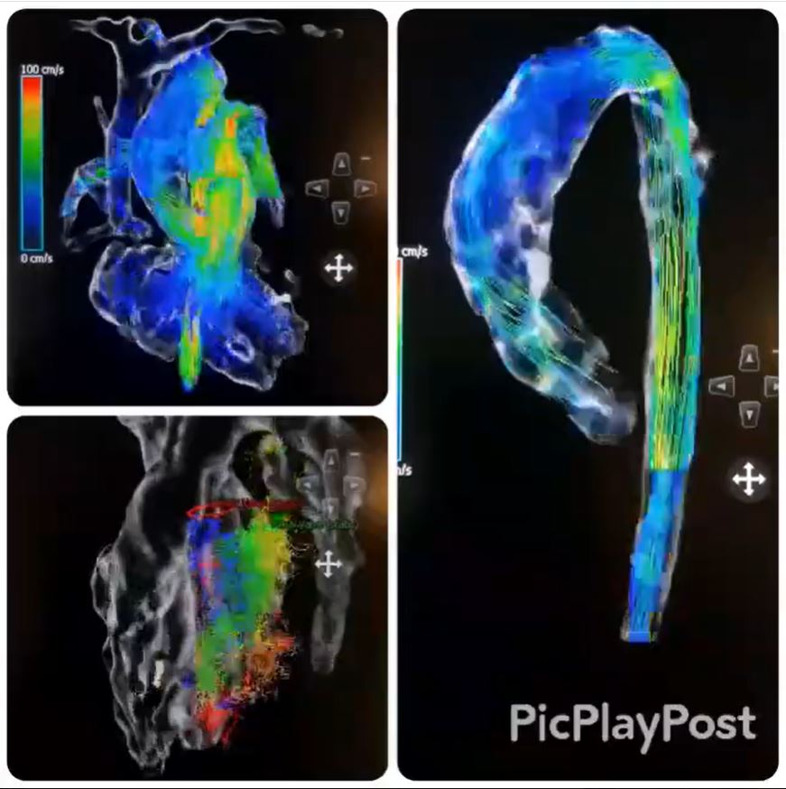Manuel Barreiro-Perez (@manuelbarreirop) on Twitter photo Undoubtedly, a proven success! 🚀 At <a href="/Hosp_ACunqueiro/">H.ÁlvaroCunqueiro</a>, we embraced the same vision by launching our Advanced Cardiovascular Imaging Unit in 2021—where cardiologists & radiologists work side by side, sharing roles & responsibilities equally. 🤗 Undoubtedly, a proven success! 🚀 At <a href="/Hosp_ACunqueiro/">H.ÁlvaroCunqueiro</a>, we embraced the same vision by launching our Advanced Cardiovascular Imaging Unit in 2021—where cardiologists & radiologists work side by side, sharing roles & responsibilities equally. 🤗