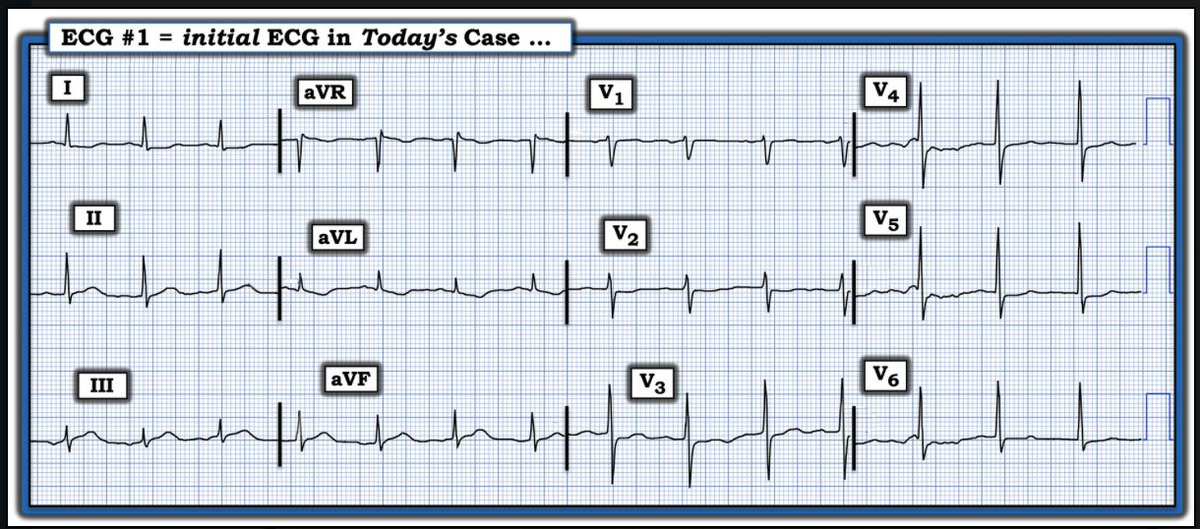 This ECG is from a man in his 60s — who presented to the ED with 2-3 days of intermittent CP (Chest Pain) — and now a 1 hour duration of 10/10 CP. — In view of this history— How do YOU interpret this ECG?— GO TO — tinyurl.com/KG-Blog-474 —#ECG - #ECG_Ken_Grauer - #EKG — :)