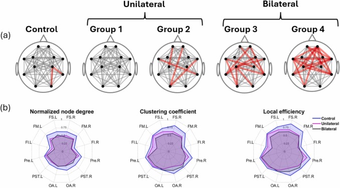 andresquiroga87's tweet photo. 🚨 New Research Alert! 🚨

Check our latest study explores how fNIRS can assess brain connectivity in carotid artery stenosis (CAS) patients! 🧠

📖 Read more: https://t.co/ClXcBoxld7

#Neuroscience #fNIRS #BrainConnectivity #Neuroimaging #MedicalResearch https://t.co/4SxqSGAaUz