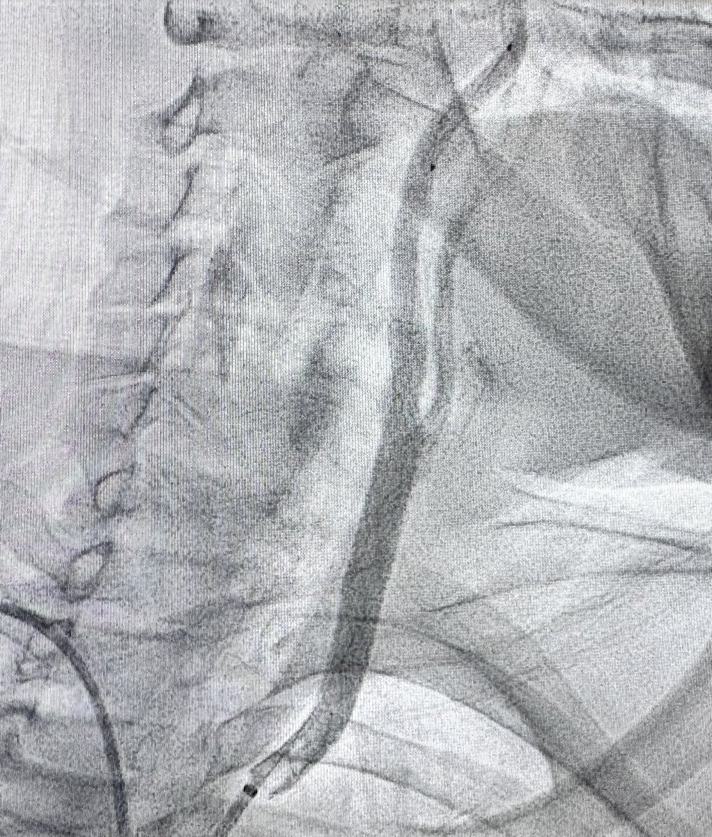 Jon George (@jcgeorgemd) on Twitter photo #CarotidCaseFiles: not all #carotidstent cases are equal! Low threshold to consider radial access with aortic cusp loop to simplify complex type 3 aortic arch engagement!
<a href="/ReVascMed/">ReVascMed</a> <a href="/GPAngioClub/">Phila Angio Club</a> <a href="/ACVCPhila/">Academy for CardioVascular Collaboration</a> #CarotidCaseFiles: not all #carotidstent cases are equal! Low threshold to consider radial access with aortic cusp loop to simplify complex type 3 aortic arch engagement!
<a href="/ReVascMed/">ReVascMed</a> <a href="/GPAngioClub/">Phila Angio Club</a> <a href="/ACVCPhila/">Academy for CardioVascular Collaboration</a>