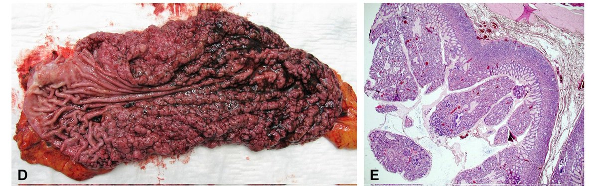 LumirKunovsky's tweet photo. 🔪 Therapeutic approach:
1️⃣ #ESD or 2️⃣ Total #Gastrectomy
for #GAPPS patients❓️❓️🤔
@SAGES_Updates
@AmCollSurgeons
@Gio_Marchegiani
@yazmaeda
🔪 #Surgery #SurgTwitter
🔬 #Pathology #PathTwitter
@sepdigestiva @GIscope_updates https://t.co/WxVa50L5N2