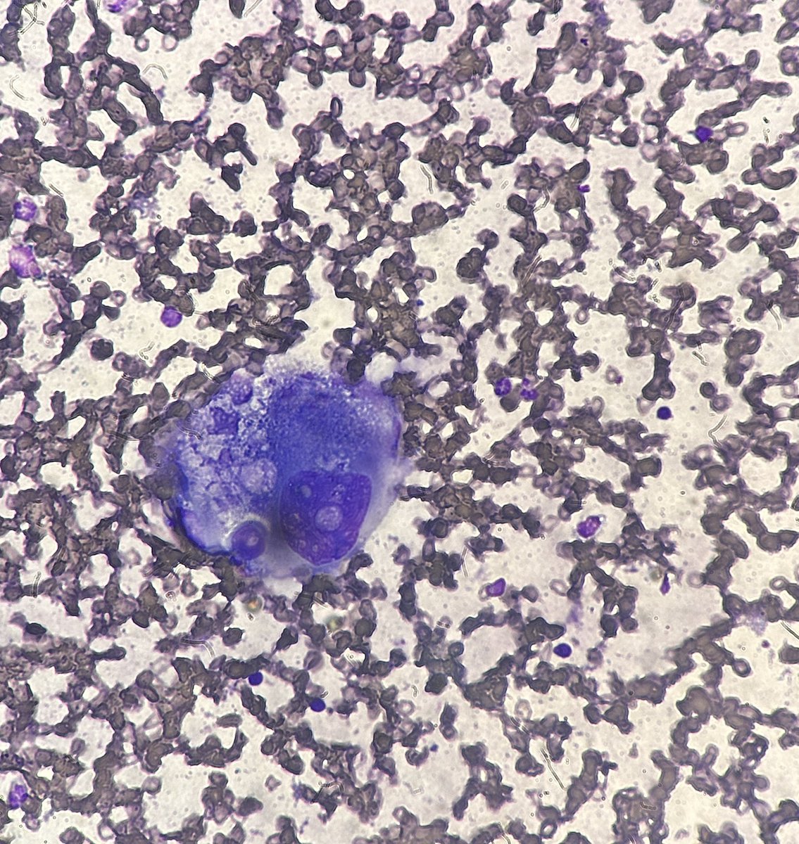 Path4People's tweet image. Metastatic breast carcinoma in a liver 

Diagnosed via Core Needle Biopsy 

#cytopath #pathx #breastpath #gipath