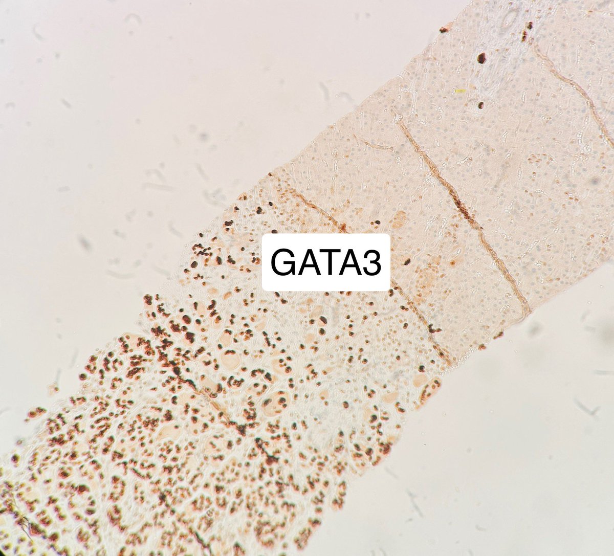 Path4People's tweet image. Metastatic breast carcinoma in a liver 

Diagnosed via Core Needle Biopsy 

#cytopath #pathx #breastpath #gipath