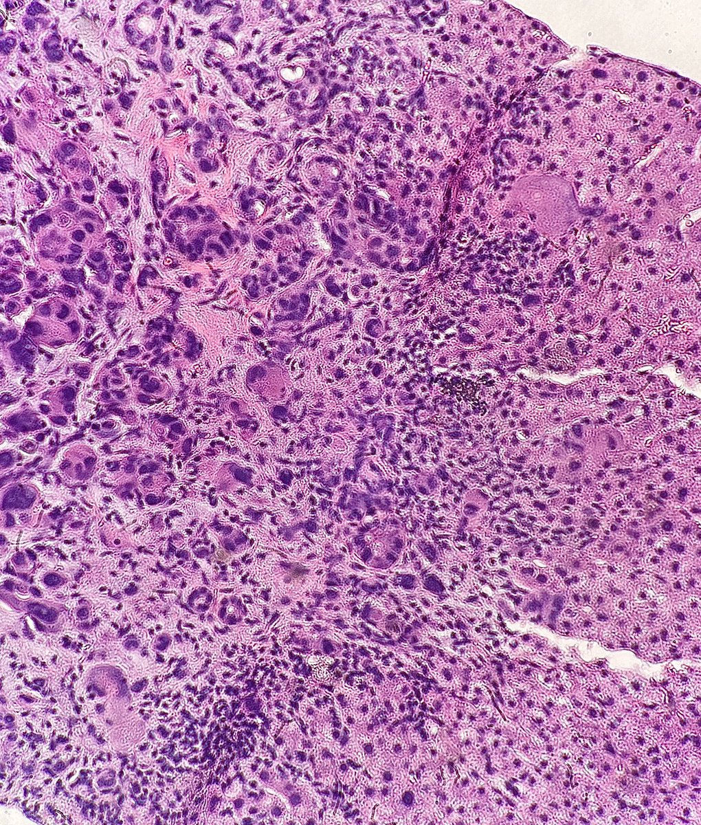 Path4People's tweet image. Metastatic breast carcinoma in a liver 

Diagnosed via Core Needle Biopsy 

#cytopath #pathx #breastpath #gipath