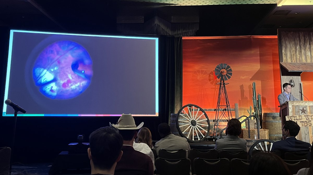 Retina Today (@retinatoday) on Twitter photo The last #wildwildVBS session was a heavy-hitter covering surgical complications. Everyone learned how to manage iatrogenic macular holes, laser gone wrong, retinal tears during nucleus removal, and more. <a href="/VitBuckleSoc/">VBS - Vit Buckle Society</a> <a href="/YoungMDConnect/">YoungMD Connect</a> #wildwildVBS #retina The last #wildwildVBS session was a heavy-hitter covering surgical complications. Everyone learned how to manage iatrogenic macular holes, laser gone wrong, retinal tears during nucleus removal, and more. <a href="/VitBuckleSoc/">VBS - Vit Buckle Society</a> <a href="/YoungMDConnect/">YoungMD Connect</a> #wildwildVBS #retina