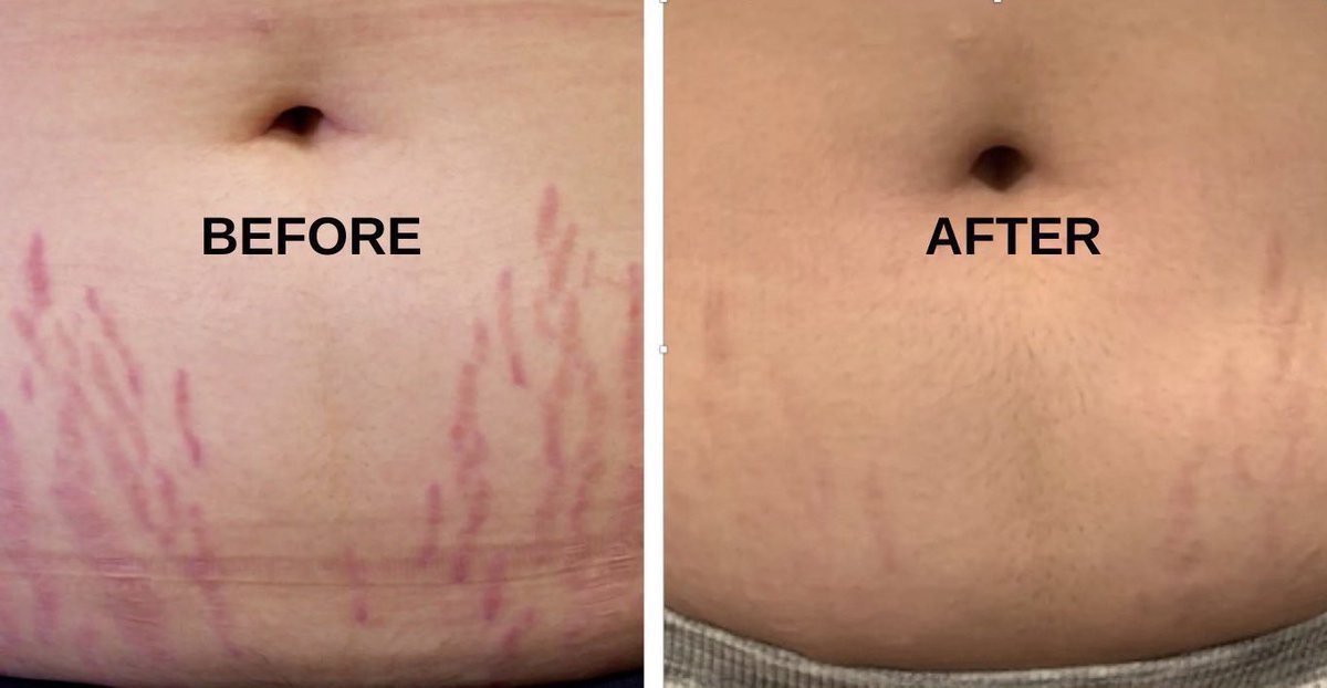 Bila kita gain weight or lose weight mendadak, akan ada strech mark yang muncul especially dekat peha, perut, betis &amp; lengan.

Lagi2 kalau pregnant 🥹

I nak share stretch mark cream yang berkesan untuk pudarkan stretch mark..