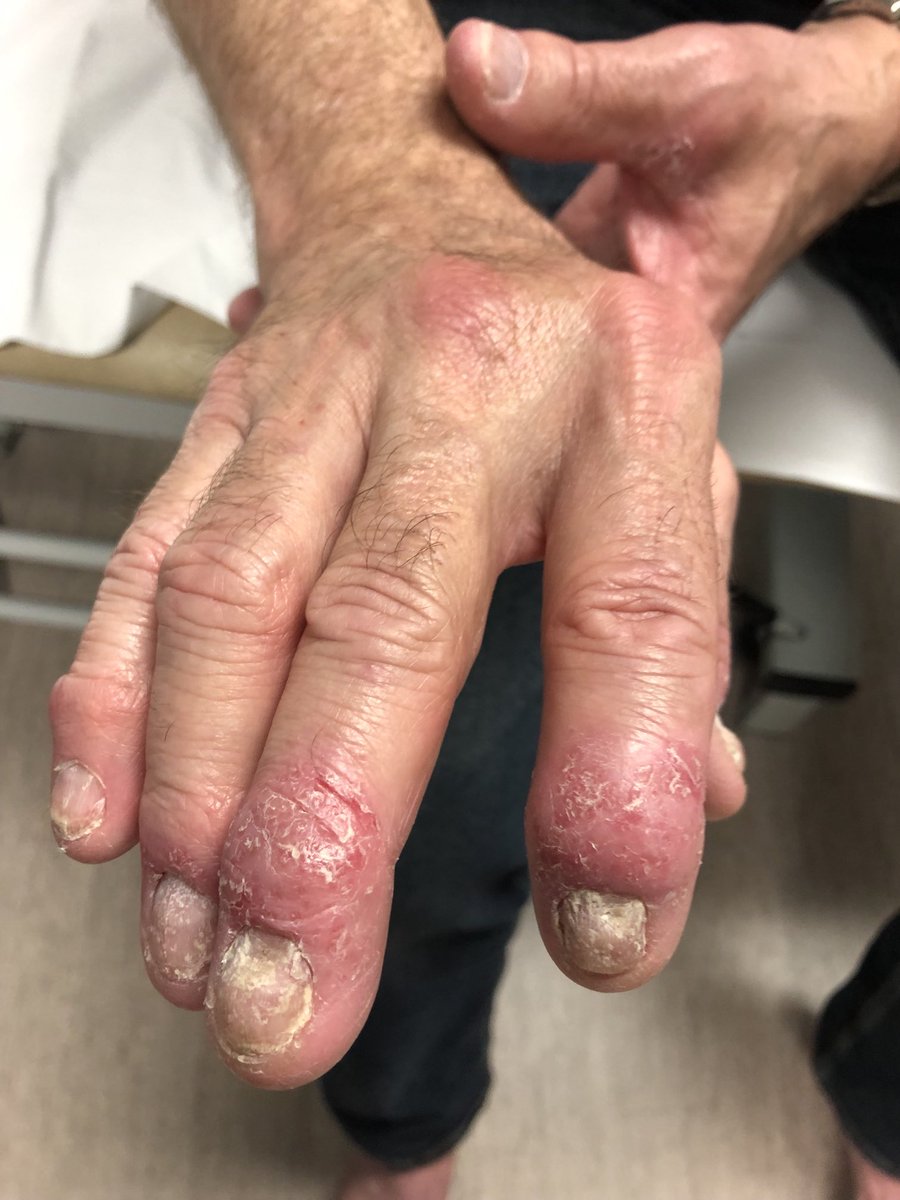 Janetbirdope's tweet image. #Diagnosis in 1 #picture

Note 
👇
nails
Rash
Enlarged #DIPs and 2nd #finger 

#ClinicalPearl

#MedEd #MedX #RheumX #RheumEd