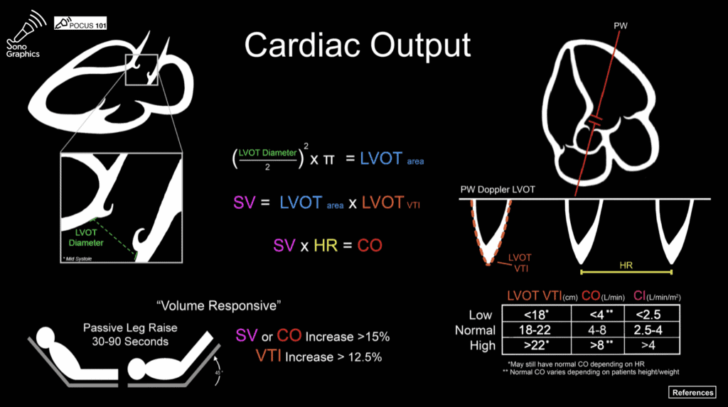 Ahmedata7777's tweet photo. Cardiac output by ECHO

1. LVOT VTI: Stroke distance 
2. LVOT VTI × LVOT AREA: Stroke volume 
3. Stroke volume × HR: CO
4. Assess for fluid responsiveness(Preload responsive) by doing Passive leg raising test and check for increase in Stroke distance or volume in shock state https://t.co/jgjlfAXIz4