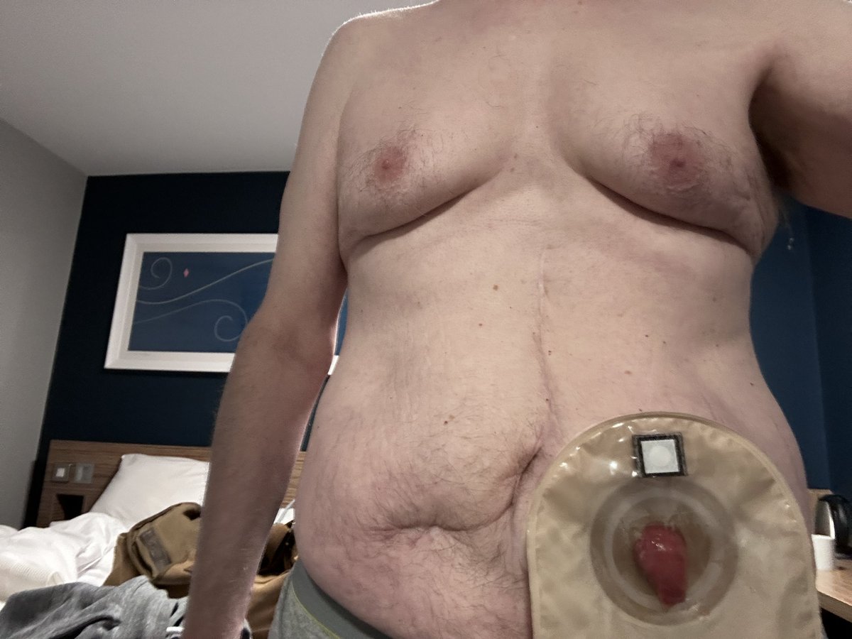 merman1974's tweet image. This is me - last night ready for the #GetYourBellyOut charity ball, this morning showing my #stoma due to #Crohns to raise donations &amp;amp; awareness

Donate £5 - text GYBO to 70970
Donate £10 - text GYBO to 70191
Help fund support, research, events and more (+Gift Aid if you can)
