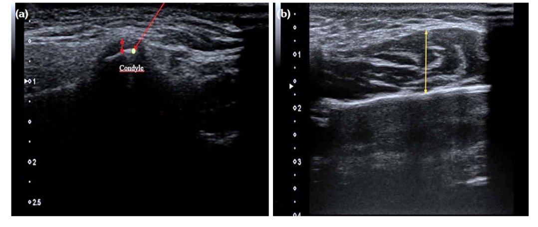 "Temporomandibular joint disorder in rheumatoid arthritis: A cross-sectional ultrasonographic study" aiming to investigate the TMJ involvement and dysfunction in patients with RA both clinically and ultrasonographically 👇
archivesofrheumatology.org/full-text/1643