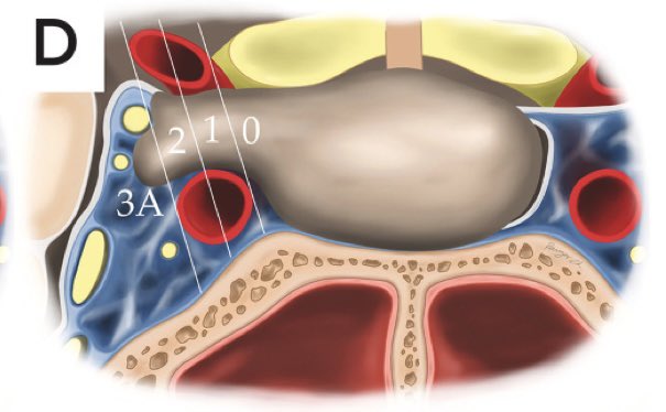 ChavezRamzes's tweet image. 🧵
What You Need to Know About Pituitary Neuroendocrine Tumors (PitNETs) 🧠🧪
They can invade, recur, and cause endocrine chaos. Here’s your neurosurgical breakdown.
#Neurosurgery #PitNET #Endocrinology #WHO2021