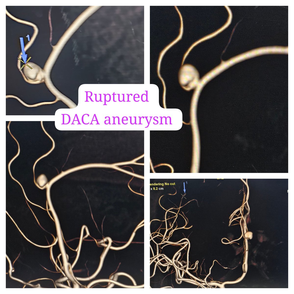 SharathKumarGG7's tweet image. Proud to Start the Neurointerventional Radiology services in the longest serving hospital of the State from 1886 [St Marthas], a 450 bedded hospital spread across 18 acres of land in the heart of Bangalore city #Coiling #Aneurysm #BrainAneurysm #Endovascular #Intervention #INR