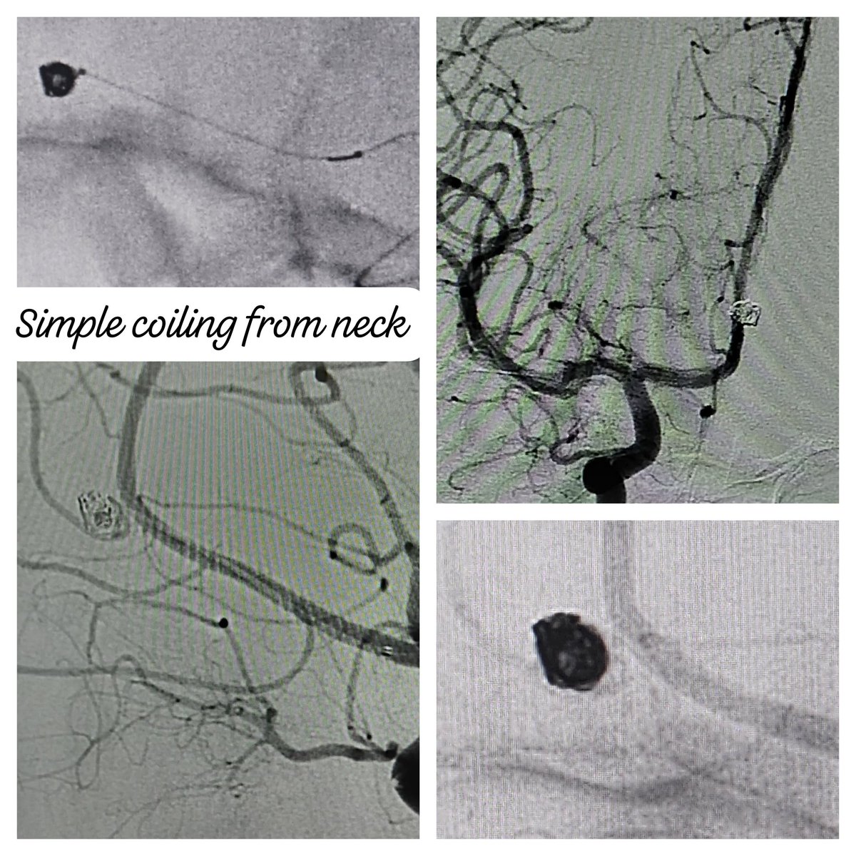 SharathKumarGG7's tweet image. Proud to Start the Neurointerventional Radiology services in the longest serving hospital of the State from 1886 [St Marthas], a 450 bedded hospital spread across 18 acres of land in the heart of Bangalore city #Coiling #Aneurysm #BrainAneurysm #Endovascular #Intervention #INR
