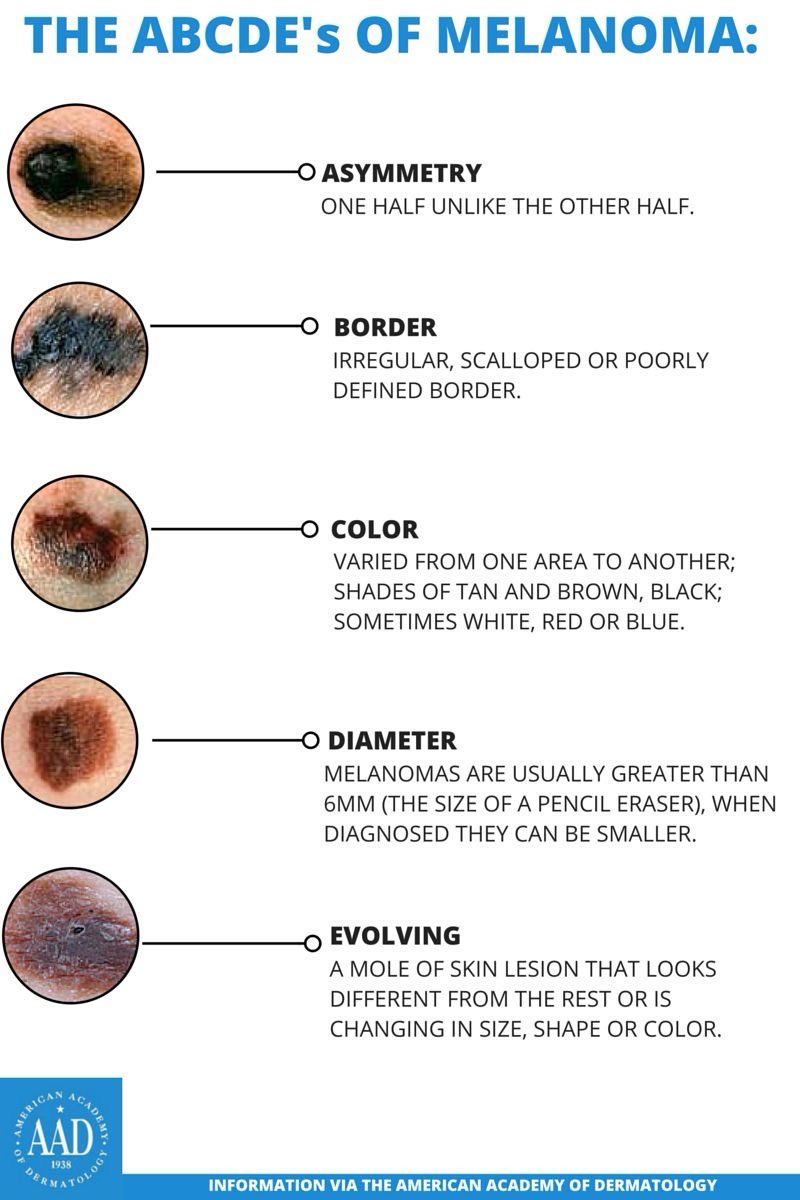 Melanoma ABCDE