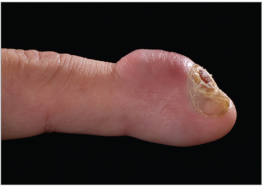 50 އަހަރުގެ މީހެއްގެ އިނގިލީގައި އަހަރެއްވަންދެން މަޑުމަޑުން ބޮޑުވަމުންދިޔަ މީތި ނަގާބެލިއިރު އެއީ ޓިއުމަރެއް

މަޑުމަޑުން ބޮޑުވެ ކަށިގަނޑާއި ނިޔަފަތިވެސް ގިރަމުންދިޔަ
ބައެއްފަހަރު ތަދުވެ، ހުޅުރަތްވެ، ހުޅަށްލޭއަރާފަހުރޭ

jamanetwork.com/journals/jamad…