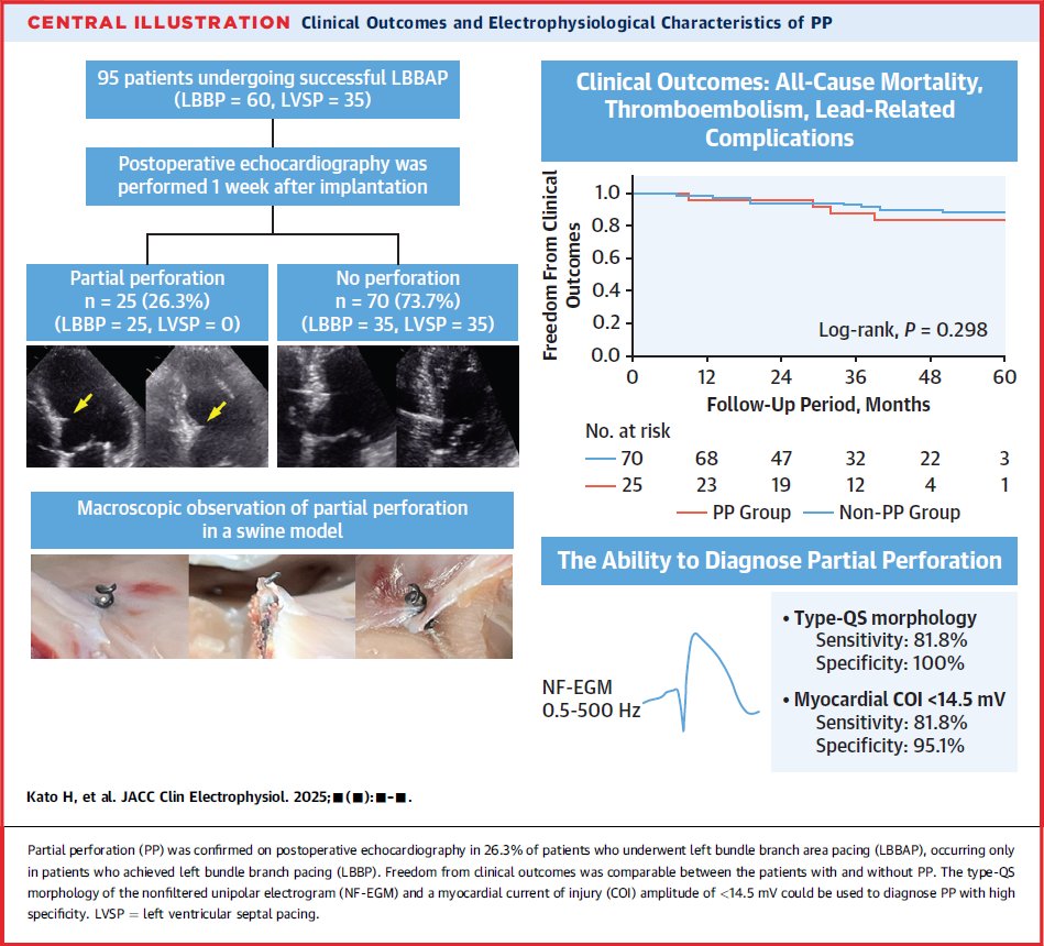 curilakarol (@curilakarol) on Twitter photo This is an essential study on partial perforations (PP) during LBBAP. QS pattern was 100% specific for PP, and PP did not increase thromboembolic event rates.
The methodological question remains: how accurate is the TTE for detecting PP?
doi.org/10.1016/j.jace…
<a href="/OCanoPerez/">Óscar Cano</a> This is an essential study on partial perforations (PP) during LBBAP. QS pattern was 100% specific for PP, and PP did not increase thromboembolic event rates.
The methodological question remains: how accurate is the TTE for detecting PP?
doi.org/10.1016/j.jace…
<a href="/OCanoPerez/">Óscar Cano</a>