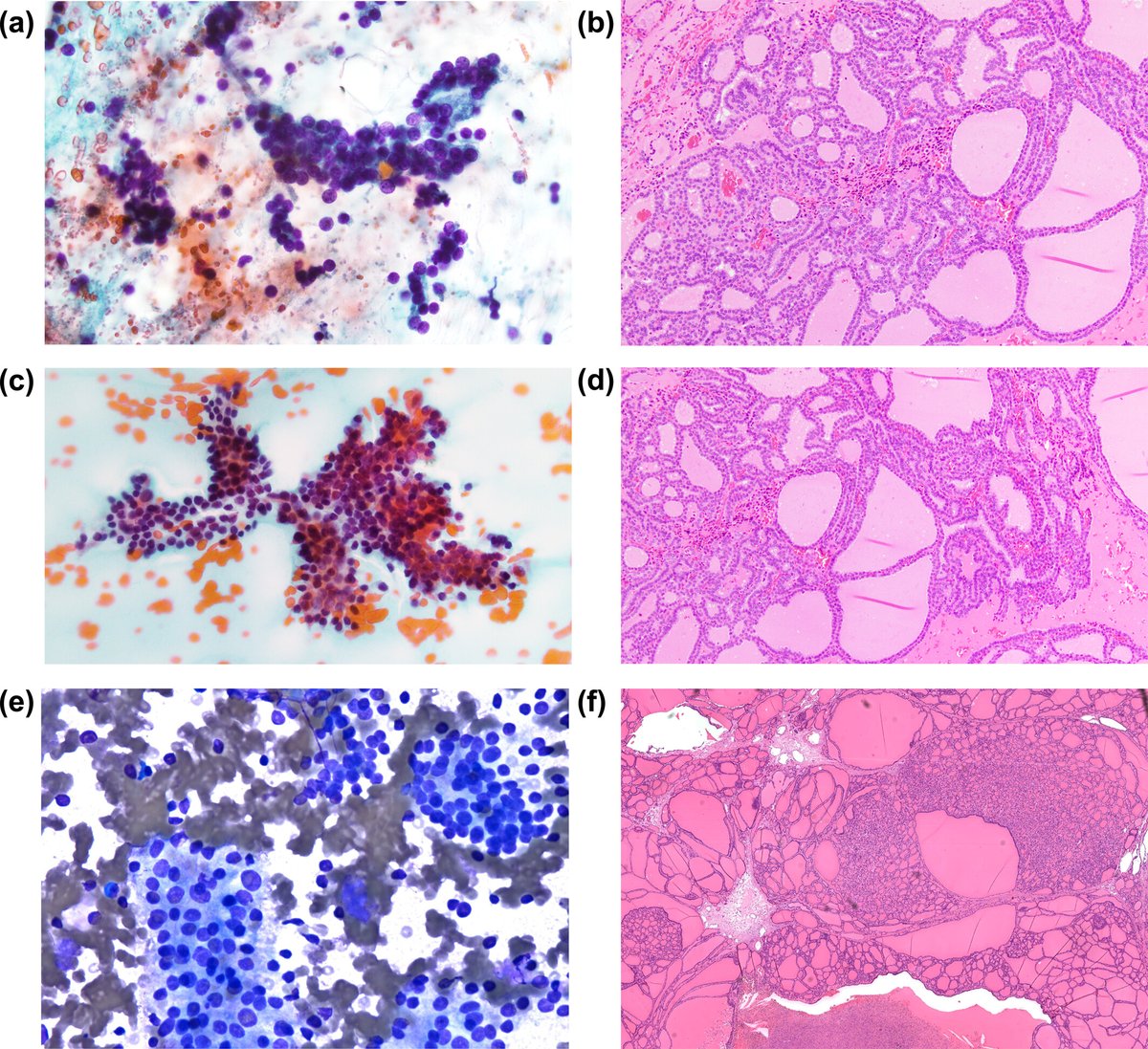 Cancer Cytopathology (@cancercytopath) on Twitter photo #USCAP2025 | Following <a href="/Sinchita_Roy/">Sinchita Roy MD PhD</a>'s presentation, our EIC <a href="/bfaquin/">WC Faquin, MD, PhD</a> presents on the <a href="/WHO/">World Health Organization (WHO)</a> Reporting System for Head and Neck Cytopathology. Dr. Faquin co-authored this 2024 article on thyroid nodules w/ DICER1 mutations or PTEN alterations: acsjournals.onlinelibrary.wiley.com/doi/10.1002/cn… #CytoPath #USCAP2025 | Following <a href="/Sinchita_Roy/">Sinchita Roy MD PhD</a>'s presentation, our EIC <a href="/bfaquin/">WC Faquin, MD, PhD</a> presents on the <a href="/WHO/">World Health Organization (WHO)</a> Reporting System for Head and Neck Cytopathology. Dr. Faquin co-authored this 2024 article on thyroid nodules w/ DICER1 mutations or PTEN alterations: acsjournals.onlinelibrary.wiley.com/doi/10.1002/cn… #CytoPath