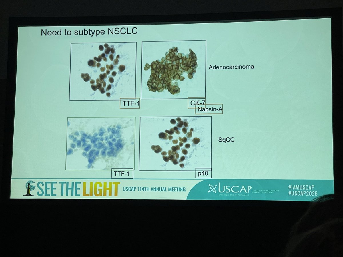 Zahra Maleki, MD, MIAC (@zmaleki_cyto) on Twitter photo Professor Lola Lozano presenting at Papanicolaou Society of Cytopathology at #USCAP2025
<a href="/TheUSCAP/">USCAP</a> <a href="/DianaEstherossi/">Esther Diana Rossi</a> <a href="/PathPro/">Liron Pantanowitz</a> <a href="/IvanaKholova/">Ivana Kholová</a> <a href="/aakasharmand/">Zubair Baloch</a> <a href="/IACytology/">International Academy Cytology</a> <a href="/mdlozanoe/">Lola Lozano</a> Professor Lola Lozano presenting at Papanicolaou Society of Cytopathology at #USCAP2025
<a href="/TheUSCAP/">USCAP</a> <a href="/DianaEstherossi/">Esther Diana Rossi</a> <a href="/PathPro/">Liron Pantanowitz</a> <a href="/IvanaKholova/">Ivana Kholová</a> <a href="/aakasharmand/">Zubair Baloch</a> <a href="/IACytology/">International Academy Cytology</a> <a href="/mdlozanoe/">Lola Lozano</a>