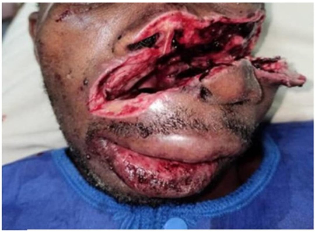 GYerathel's tweet photo. Face saved after being attacked by a panga/ machete

Great job to the surgeon's https://t.co/YH81c9euMG
