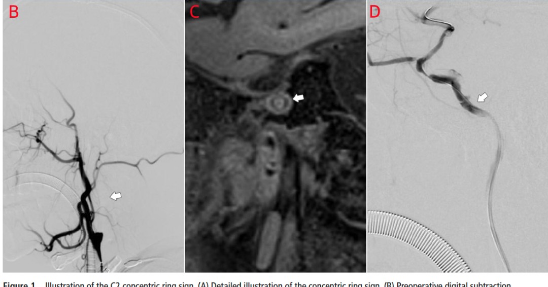 With the increase in thrombectomies for ICA occlusions with delayed presentation or for thromboendarterectomies, vessel-wall imaging MRI shows potential for distinguishing with patients will be successfully recanalized. Lu et al bit.ly/4kR9g7f report their use of VWI-MRI