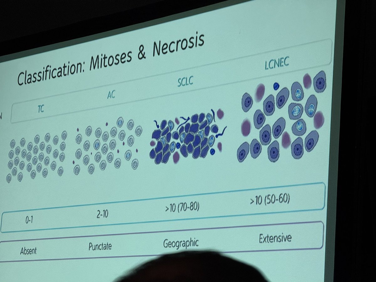 Papanicolaou Society (@papsociety) on Twitter photo <a href="/PapSociety/">Papanicolaou Society</a> scientific meeting at #USCAP2025 another great presentation by Dr. Anjali Saqi on Neuroendoctine lung neoplasms!@DianaEstherossi <a href="/DiagnosticCyto/">Diagnostic Cytopath</a> <a href="/Baskotacytopath/">Swikrity U Baskota,MD, FCAP</a> <a href="/PoonamVohra3/">Poonam Vohra MD</a> <a href="/AzizaNassar2/">Aziza Nassar</a> <a href="/IACytology/">International Academy Cytology</a> <a href="/aakasharmand/">Zubair Baloch</a> <a href="/PapSociety/">Papanicolaou Society</a> scientific meeting at #USCAP2025 another great presentation by Dr. Anjali Saqi on Neuroendoctine lung neoplasms!@DianaEstherossi <a href="/DiagnosticCyto/">Diagnostic Cytopath</a> <a href="/Baskotacytopath/">Swikrity U Baskota,MD, FCAP</a> <a href="/PoonamVohra3/">Poonam Vohra MD</a> <a href="/AzizaNassar2/">Aziza Nassar</a> <a href="/IACytology/">International Academy Cytology</a> <a href="/aakasharmand/">Zubair Baloch</a>