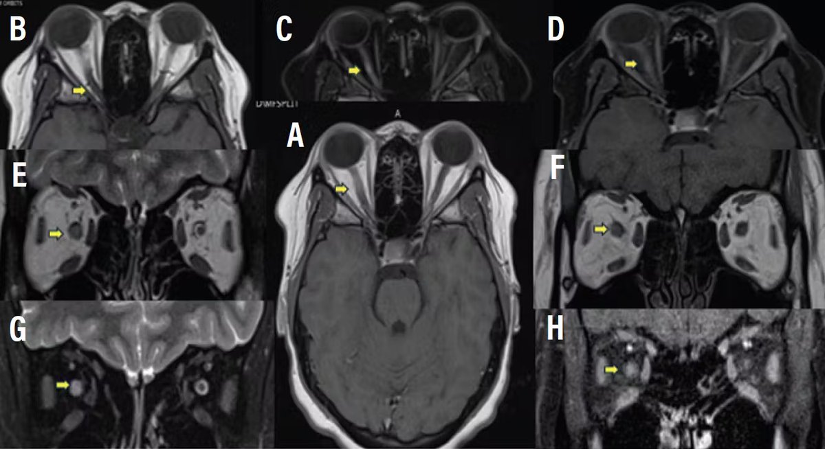 Drs. Gunturu (@Manasa_Gunturu), Sguigna (<a href="/dr_sguigna/">DrSguigna</a>), and Truong-Le (<a href="/MelanieNga/">Melanie Trương-Lê DO OD</a>) discuss how #neuroopthalmic evaluations assist #MS diagnosis using the 2024 McDonald criteria.
practicalneurology.com/articles/2025-…

<a href="/mssociety/">National MS Society</a> <a href="/AANmember/">American Academy of Neurology</a> <a href="/mscare/">CMSC</a> <a href="/ACTRIMS/">ACTRIMS®</a> <a href="/ACPIMPhysicians/">ACP</a> <a href="/UMMCnews/">The University of Mississippi Medical Center</a>