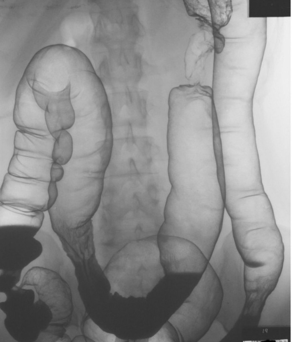 Image of the colon on barium enema. What’s the diagnosis?
