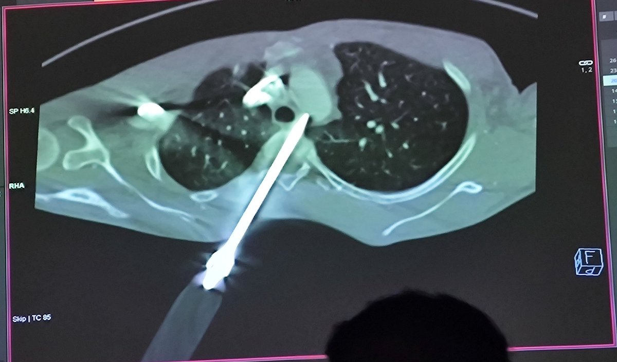 "The one who saves is greater than the one who kills."
Experienced this Great Indian philosophy today. CT report, FB through spinal canal, close proximity to oesophagus and indenting Aorta.
Intraop - no spinal, oesophagus, aortic injuries. Pt. Stable, no neuro deficit.