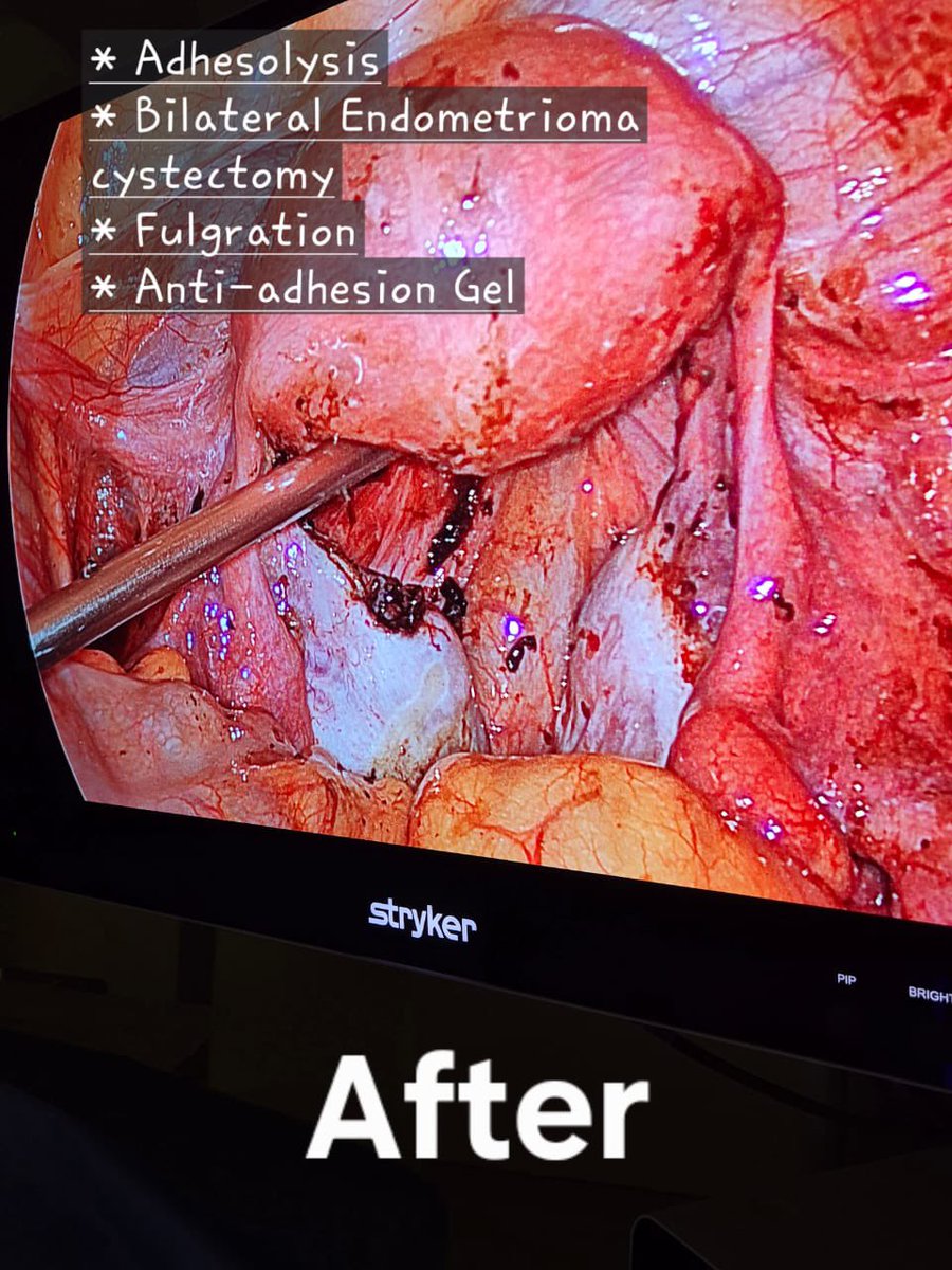 Endometriosis 🤨 جراحة البطانة المهاجره بواسطة المنظار