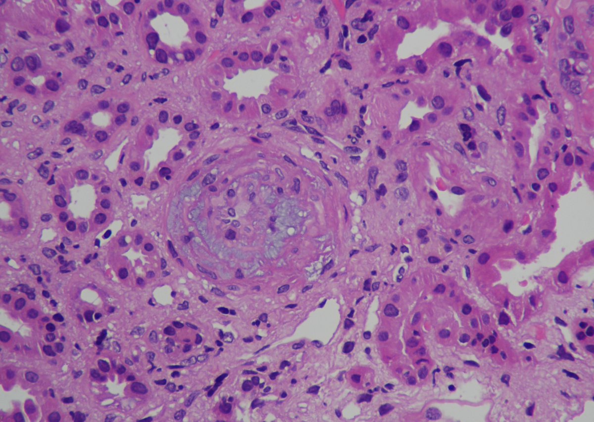 Jithu Kurian🇮🇳 (@jithukurian6) on Twitter photo 🔥 what are the following images from a renal allograft show ?
🔥 Join us for a detailed discussion on this case at
⏰ 9 pm on 24 th march 2025
<a href="/sabarivenus/">SABARINATH S MD,DM,PDF(Renal Tx),FASN,FISN</a> <a href="/priti899/">Dr Priti MD,FASN🇮🇳 (प्रिति)</a> <a href="/GlomCon/">GlomCon</a> <a href="/nephromythri/">Mythri Shankar 🇮🇳</a> <a href="/divyaa24/">Dr. Divya Bajpai 🇮🇳</a> <a href="/thisis_drgsp/">Dr Ganesh Srinivasa Prasad</a> <a href="/iamnephrologist/">Sourabh Sharma</a> <a href="/isn_india/">Indian Society of Nephrology</a>
<a href="/arvindcanchi/">Arvind Canchi (Conjeevaram)🇮🇳</a> <a href="/drshyambansal/">Shyam Bansal</a> 🔥 what are the following images from a renal allograft show ?
🔥 Join us for a detailed discussion on this case at
⏰ 9 pm on 24 th march 2025
<a href="/sabarivenus/">SABARINATH S MD,DM,PDF(Renal Tx),FASN,FISN</a> <a href="/priti899/">Dr Priti MD,FASN🇮🇳 (प्रिति)</a> <a href="/GlomCon/">GlomCon</a> <a href="/nephromythri/">Mythri Shankar 🇮🇳</a> <a href="/divyaa24/">Dr. Divya Bajpai 🇮🇳</a> <a href="/thisis_drgsp/">Dr Ganesh Srinivasa Prasad</a> <a href="/iamnephrologist/">Sourabh Sharma</a> <a href="/isn_india/">Indian Society of Nephrology</a>
<a href="/arvindcanchi/">Arvind Canchi (Conjeevaram)🇮🇳</a> <a href="/drshyambansal/">Shyam Bansal</a>