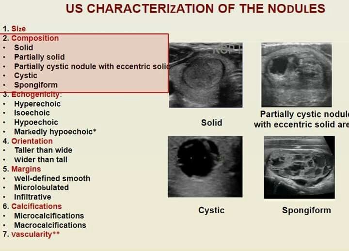 ultrasound charactrization of the nodules 
#ultrasound 
#sonologist