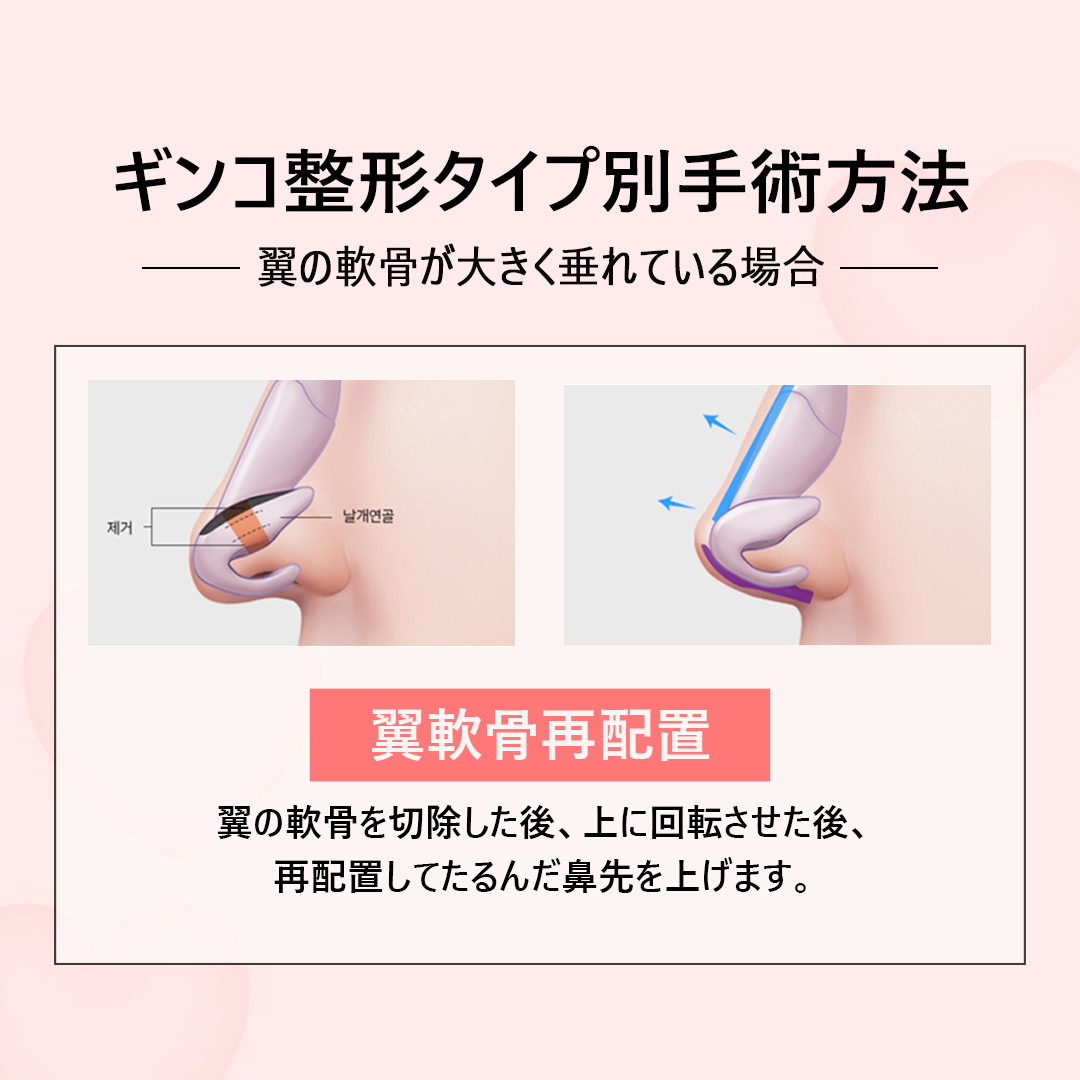 diprsjp's tweet photo. 今日は鼻が全体的に長くて悩んでいる方のために
ギンコ整形の説明をしてみようと思います~！🥳🥳

顔の比率を分析すると、額、眉間から鼻先まで
そして鼻の下からあごの先まで1:1:1の割合が最も理想的な黄金比率だと言えます。
この中で鼻が長くなると黄金比率は割れ、鼻によって
顔が大体長く見えて老眼の印象を持つようになります。🥲🥲

長い矯正を話す前に長い鼻の定義について簡単に言うと
鼻の長さは鼻筋が出発する目と目の間の鼻の一番低い地点から
鼻先の下までの長さを意味します。 🤓
そのため、鼻の長さを決めるのは鼻の甲と鼻先になります。

特に鼻先が長く、下に降りてくると正面から見た時
矢印の形に見えることから、ヤッコとも呼ばれます。
この中で鼻先が落ちたり下に長い場合は、実際の年齢より
よりよく見える印象を持たせます！🎀👑👗

それでは解決策は~？🙄

したがって、このような患者の鼻の整形を計画する時は
鼻先を高めながら同時に高くした鼻先が唇と成す角度である鼻唇角を
もう少し上げる方向で計画されます。
このため、下に垂れた軟骨を上に再配置させる
軟骨の再配置と比重格をもう少し前に延ばす比重格延長術を並行することになります。
さらにしっかり鼻先の支持構造を作り
鼻先の高さを高め、鼻唇角を上げて長い鼻を改善します。😆👍🏻👍🏻

ディーアイ整形外科では、ギンコ矯正·ギンコ整形経歴専門医のチョン·ヨンイク代表院長が❤
1:1専担して鼻の整形に関する相談から手術計画、施行、治療、経過診療までの
すべての過程を直接行っており、よりレベルの高い医療サービスを受けることができます。🙏🏻🙏🏻

 @574lbeop  https://t.co/YpKlZ5bLE2 

 #韓国整形外科 #韓国鼻整形 #韓国整形 #韓国鼻手術 #韓国整形情報 #韓国整形症例 #鼻整形症例 #韓国鼻整形症例 #鼻フル #団子鼻 #短い鼻 #自己肋軟骨 #鼻肋軟骨 #肋軟骨手術 #鼻手術 #鼻整形 #鼻再手術 #ハンプ手術 #ハンプ鼻 #ハンプ鼻手術 #鼻整形 #韓国鼻整形 #プロテーゼ #鼻中隔延長 #韓国鼻整形おすすめ #韓国整形外科おすすめ #韓国整形外科 #DI整形外科