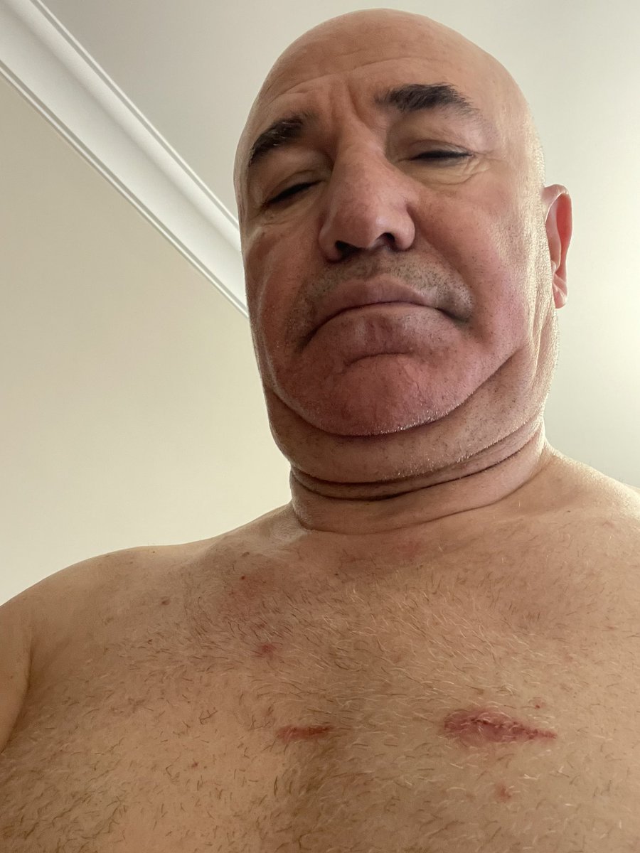 MTanal's tweet image. Bu Yaralar Sadece Bedende Değil, Hukuk Devletinde Açılmıştır!”

Tam 48 saattir sahadaydım. Çağlayan Adliyesi’nden Saraçhane’ye, oradan tekrar adliyeye… Evime dahi uğrayamadım, üzerimi başımı değiştiremedim. Polis saldırısı sırasında gömleğim yırtıldı ve bu sabah üzerimi…