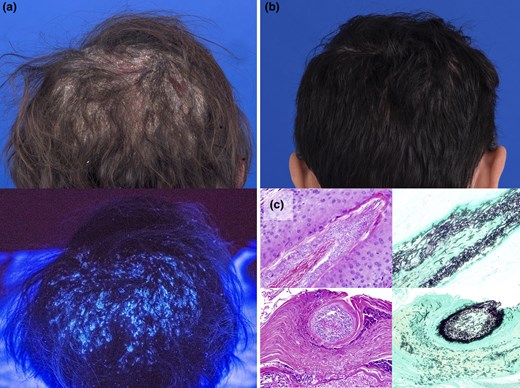 A challenging case of tinea capitis in a patient with WHIM syndrome unresponsive to multiple treatments. The case highlights the potential link between WHIM syndrome and dermatophyte infections and the role of posaconazole in treatment. Read more here: doi.org/10.1093/skinhd…