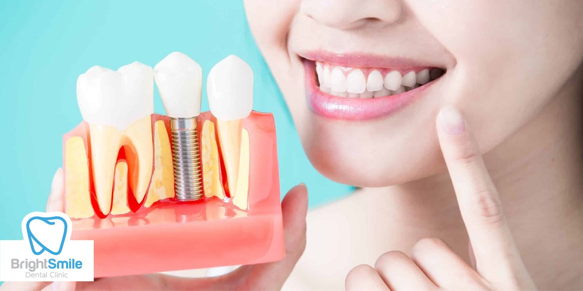 BrightSmileBdrm's tweet photo. 📷+90 542 785 31 35
https://t.co/ZJDMXyA3b4
#bodrum #BrightSmileDentClinic #brightsmile #medicaltravelbodrum #dentalclinic #dentist #teethcrown #teethveneer #bodrumdentist #cos #crowns #veneer #implants #dentista #teeth #teethwhitening #dent #oralhealth #dentalhealth #oralcare https://t.co/auAAFu6PbI