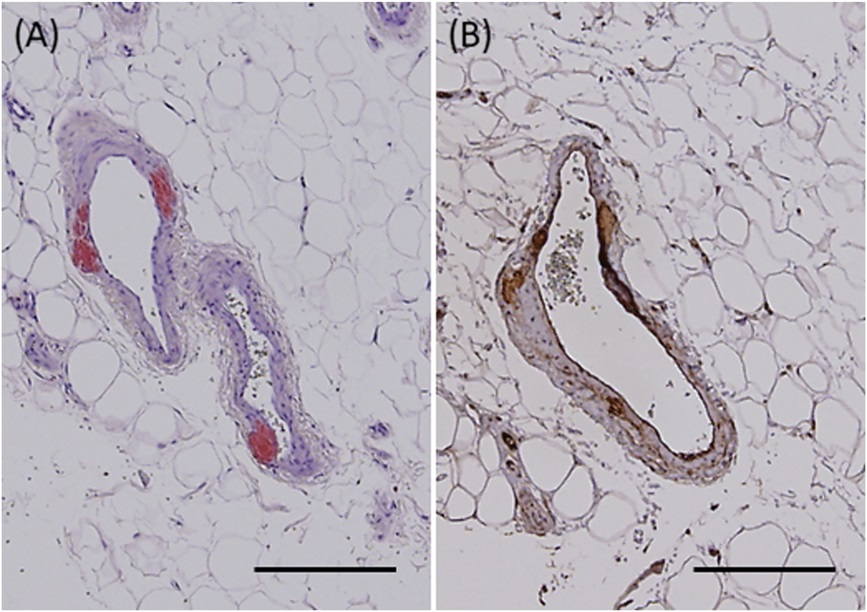 AJDP_Journal's tweet photo. #WhatsNewInDermpath
A skin biopsy of the abdominal wall without a rash is safe and effective in the diagnosis of systemic amyloidosis.
- It can provide a high amyloid detection rate in comparison to abdominal subcutaneous fat aspiration (ASFA).
https://t.co/lQ6o0O0zwF https://t.co/lBaFD2jLTf