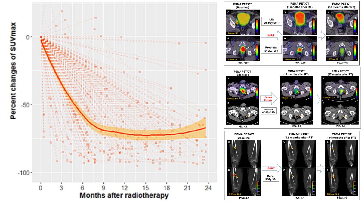 Jeremie Calais (@calaisjeremie) on Twitter photo Kinetics of PSMA PET signal after radiotherapy in 217 prostate cancer lesions: It takes multiple months for the uptake to decrease (> 6 months). Beware of "pseudo-progression" on PSMA PET performed shortly after RT. <a href="/RO_GreenJournal/">Radiotherapy & Oncology</a> <a href="/masatoshihotta/">Masatoshi Hotta</a> <a href="/UCLA/">UCLA</a>
sciencedirect.com/science/articl… Kinetics of PSMA PET signal after radiotherapy in 217 prostate cancer lesions: It takes multiple months for the uptake to decrease (> 6 months). Beware of "pseudo-progression" on PSMA PET performed shortly after RT. <a href="/RO_GreenJournal/">Radiotherapy & Oncology</a> <a href="/masatoshihotta/">Masatoshi Hotta</a> <a href="/UCLA/">UCLA</a>
sciencedirect.com/science/articl…