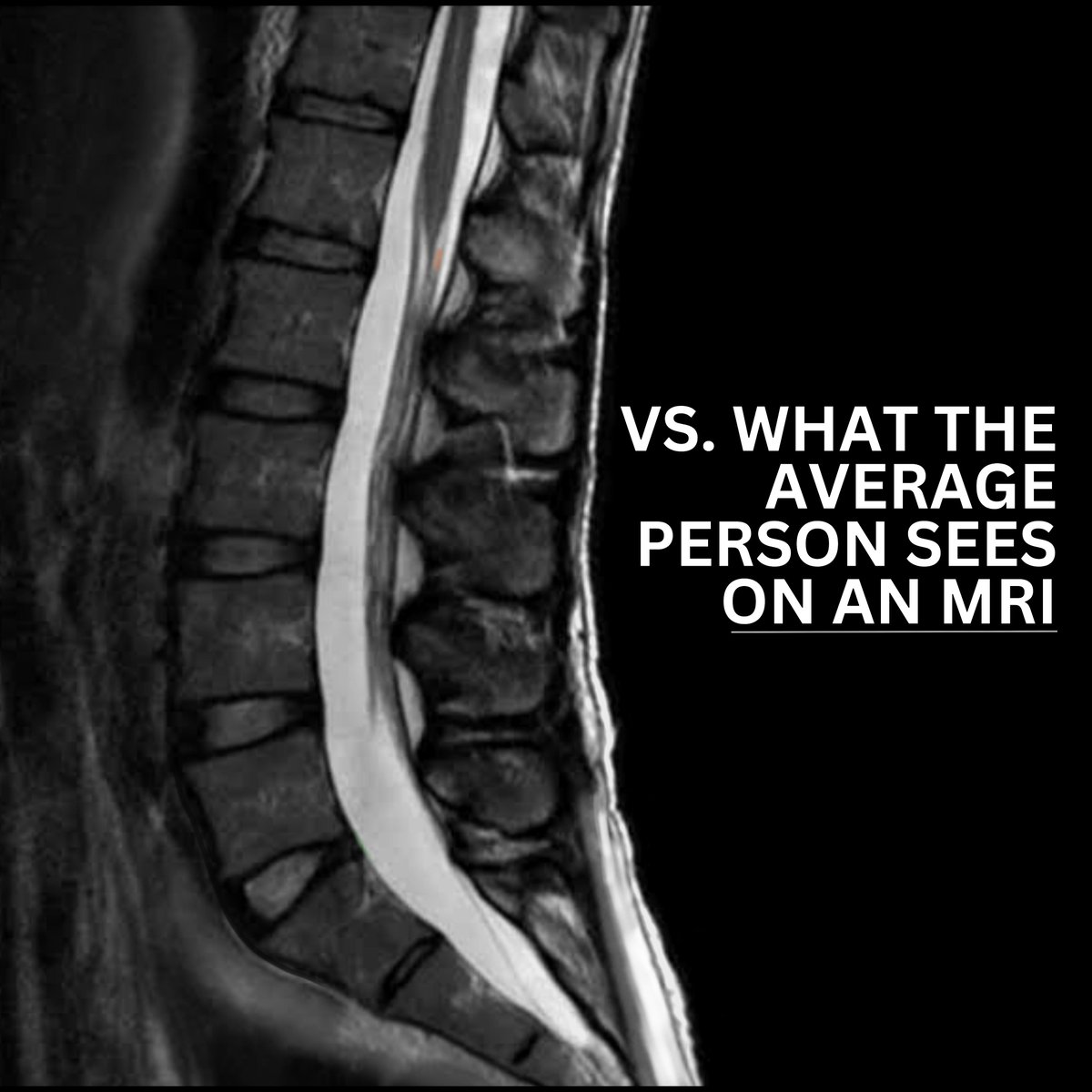Inside the mind of a neurosurgeon: what we are trained to see on an MRI. #spine #spinehealth #doctor #medical #neurosurgery #neuroanatomy #radiology #anatomy #anatomyandphysiology