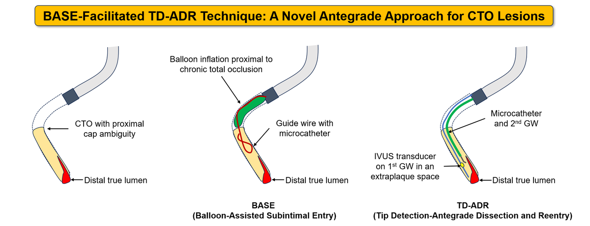 Shoichi Kuramitsu, MD, PhD, FACC, FSCAI (@skuramitsu0511) on Twitter photo Our new case report has been published online at CCI. This case indicates that the BASE-facilitated TD-ADR is a good antegrade approach for CTO lesions with ambiguous proximal cap. Congrats, Vidya!
onlinelibrary.wiley.com/doi/full/10.10…
<a href="/Laserrman/">Tsutomu Fujita MD</a> <a href="/VRejeki28/">Vidya</a> <a href="/SCVC2023/">Sapporo Cardiovascular Clinic 札幌心臓血管クリニック</a> Our new case report has been published online at CCI. This case indicates that the BASE-facilitated TD-ADR is a good antegrade approach for CTO lesions with ambiguous proximal cap. Congrats, Vidya!
onlinelibrary.wiley.com/doi/full/10.10…
<a href="/Laserrman/">Tsutomu Fujita MD</a> <a href="/VRejeki28/">Vidya</a> <a href="/SCVC2023/">Sapporo Cardiovascular Clinic 札幌心臓血管クリニック</a>