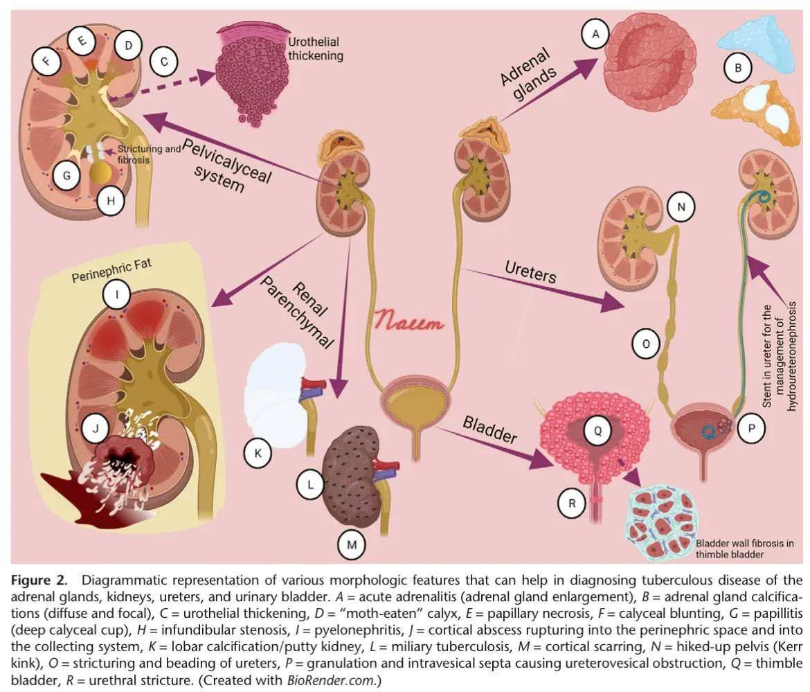 En 2025 la #tuberculosis resurge como principal causa de muerte por enfermedad infecciosa🦠😷

El tracto genitourinario es el 2° órgano➕ afectado en orden de frecuencia (después del🫁)

⬇️Te compartimos un esquema de hallazgos para el diagnóstico de TB genitourinaria #WorldTBDay
