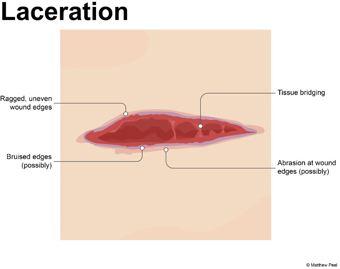 Forensic Friday Fact 🧬
Wounds healing by secondary intention are left open to heal naturally. This occurs when tissue loss is too great (or left too late) for the edges to be brought together.

#ForensicFact #ForensicHealthcare #Policecustody #SARC