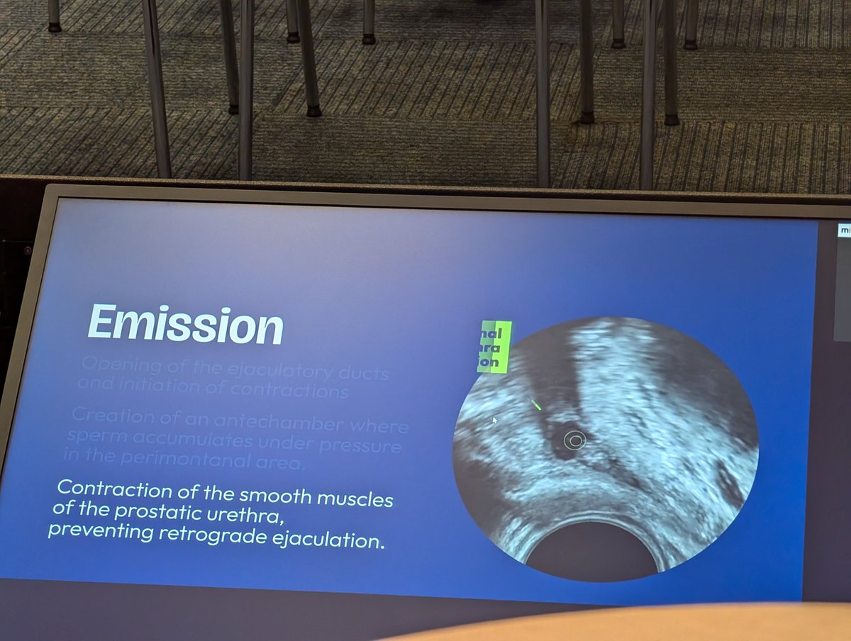 Alessandrouleri (@aleuleri) on Twitter photo Game changing presentation of the EJAC study by <a href="/BenjaminPradere/">Benjamin Pradere</a> at #EAU24
First description of the ejaculation process through tr-US and cystoscopy. Some insights:
- preservation of peri-veromontanal area is the 🗝️ to preserve ant. ejac
- no need to spare the bladder neck Game changing presentation of the EJAC study by <a href="/BenjaminPradere/">Benjamin Pradere</a> at #EAU24
First description of the ejaculation process through tr-US and cystoscopy. Some insights:
- preservation of peri-veromontanal area is the 🗝️ to preserve ant. ejac
- no need to spare the bladder neck