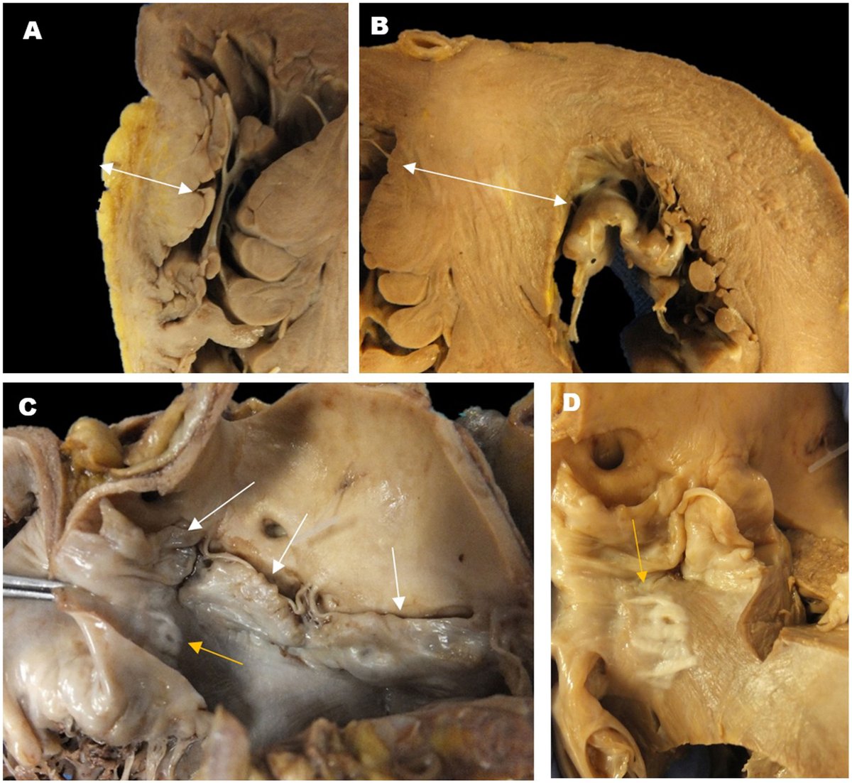 Más allá del diagnóstico post mortem de la miocardiopatía hipertrófica: enfoque genético guiado por características clínicas y morfológicas en el síndrome de Noonan. #REC #AheadOfPrint <a href="/esola_cardio/">Elena Sola-García</a>
revespcardiol.org/es-mas-alla-de…