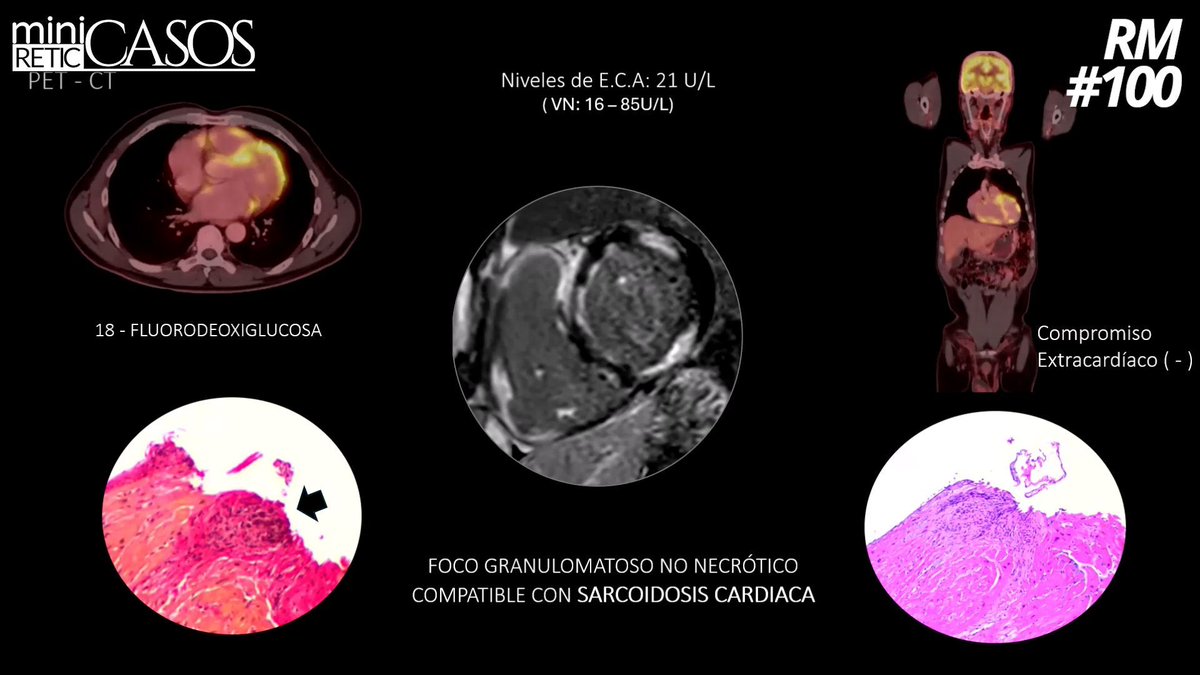 SEIC - Sociedad Española de Imagen Cardíaca (@imagencardiaca) on Twitter photo Publicamos la solución del extraordinario #miniCASO Cardio RM #100 de López Opitz <a href="/LopezOpitz/">J.Lopez-Opitz@CardioImagen_cl</a>
Rara sarcoidosis cardíaca en Chile
🔎 buff.ly/5v70gZD ◀️
Caso completo ⤴️
¿Lo viste?
#aprendeconcasos Publicamos la solución del extraordinario #miniCASO Cardio RM #100 de López Opitz <a href="/LopezOpitz/">J.Lopez-Opitz@CardioImagen_cl</a>
Rara sarcoidosis cardíaca en Chile
🔎 buff.ly/5v70gZD ◀️
Caso completo ⤴️
¿Lo viste?
#aprendeconcasos