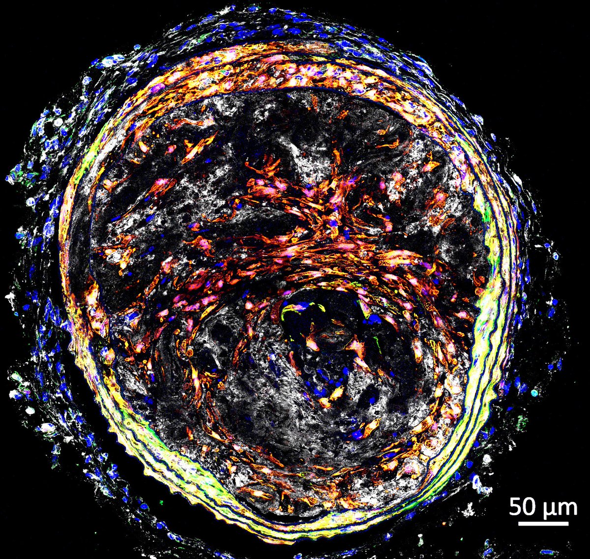 Heart Research Institute (@hriaust) on Twitter photo Under the Microscope ๐ฌ๐ฉโ๐ฌ
This image was generated by Eva and Amandeep from <a href="/AshishMisraLab/">Ashish Misra</a>.
It shows a novel murine model that genetically labels #bloodvessel cells linked to unstable #atherosclerotic plaque - using the #TandemStenosis technique with lineage tracing. Under the Microscope ๐ฌ๐ฉโ๐ฌ
This image was generated by Eva and Amandeep from <a href="/AshishMisraLab/">Ashish Misra</a>.
It shows a novel murine model that genetically labels #bloodvessel cells linked to unstable #atherosclerotic plaque - using the #TandemStenosis technique with lineage tracing.