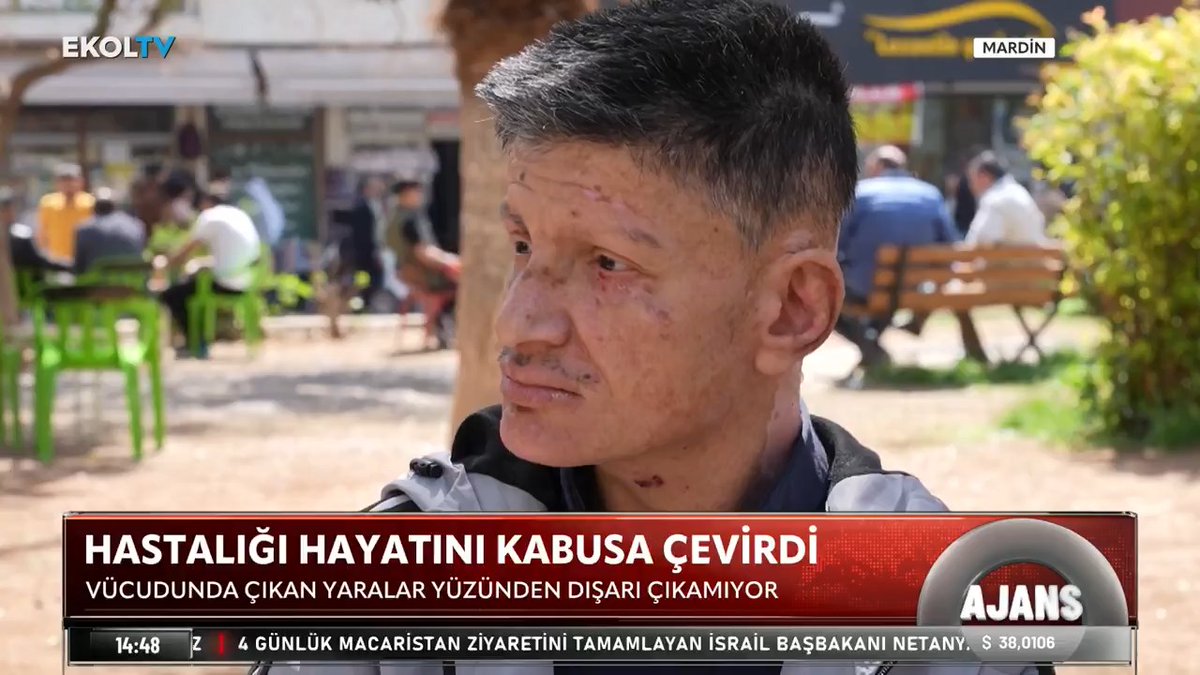 mamoste128's tweet photo. Hayatını kurtaracak ilaç çok uzakta!

Mardin’de doğuştan cilt hastası bir adam, yaşam savaşı veriyor. Umudu Japonya’daki ilaçta ama fiyatı erişilemeyecek kadar yüksek. #keşfet ekol https://t.co/bhfPkdAjU3