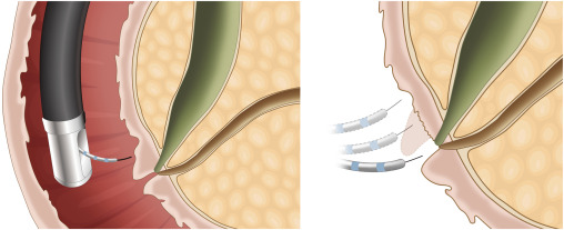 Online now in GIE’s Articles in Press: "Identification of risk factors associated with post-ERCP pancreatitis in patients with easy cannulation: a prospective multicenter observational study (with videos)" by Kyong Joo Lee et al. giejournal.org/article/S0016-…